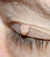 Fibrom am Augenlid